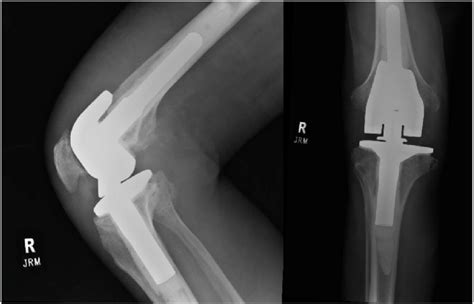 Preoperative Anteroposterior And Lateral Radiographic Views Of Knee