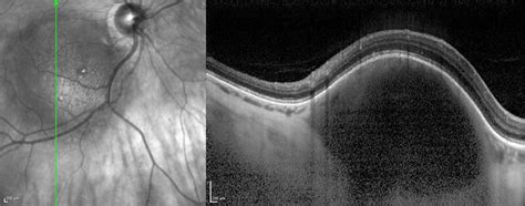 Choroidal Melanoma Fluorescein Angiography