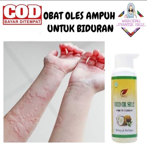 Jual Obat Biduran Paling Ampuh Obat Biduran Gatal Gatal Obat Biduran