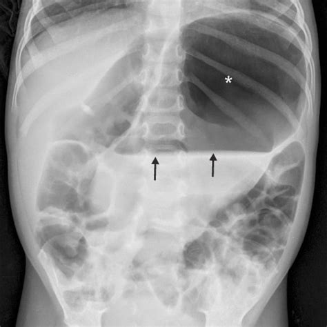 Contrast Enhanced Abdominal CT Scan Performed During The Diagnostic