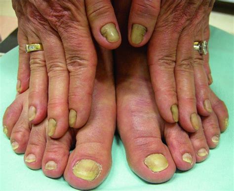 Deformities Dystrophies And Discoloration Of The Nails Skin