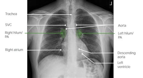 X Ray Chest Anatomy