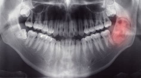 Hemangioma Oral Cavity