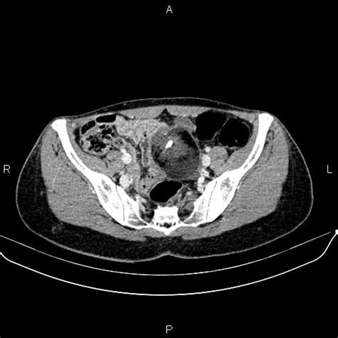 Ovarian Mature Cystic Teratoma Image