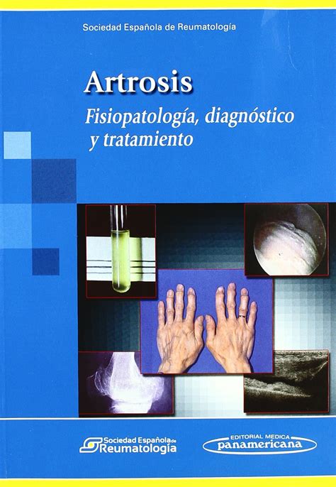 Buy Artrosis Osteoarthritis Fisiopatologia Diagnostico Y