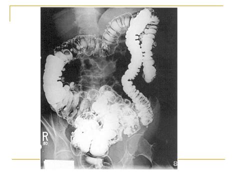 Enfermedad Diverticular Dr Almarza