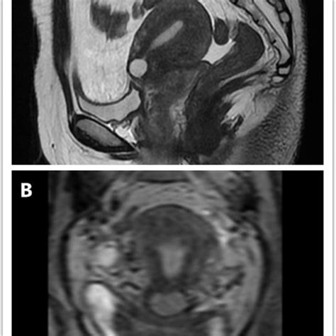 MRI Images Of Cesarean Scar Defects A Sagittal View On T2 Images B