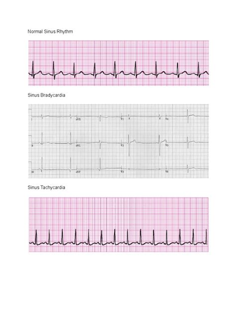 Ekg Strips | PDF