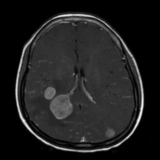 Lung cancer with Brain metastases. Three enhancing lesions seen on ...