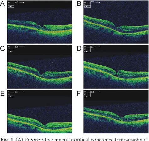 Figure 1 From Formation Of Full Thickness Macular Hole Following Pars