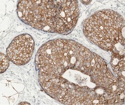 Lobular Neoplasia Morphology Biological Potential And Management In