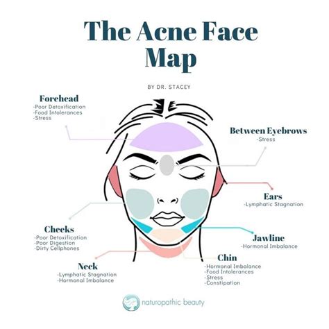 Acne Face Map What Your Breaktouts Are Telling You Face Mapping Acne Face Acne Face Mapping