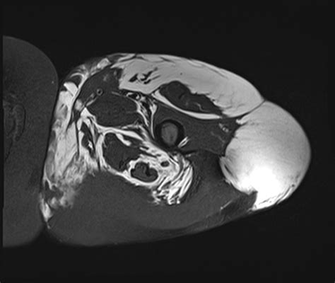 Liposarcoma Radiology