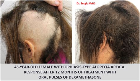 Alopecia Areata Solución causas problema tratamiento especialista