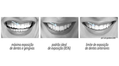 Sorriso Gengival Alto Ideal Lu S Gustavo Leite Dentista