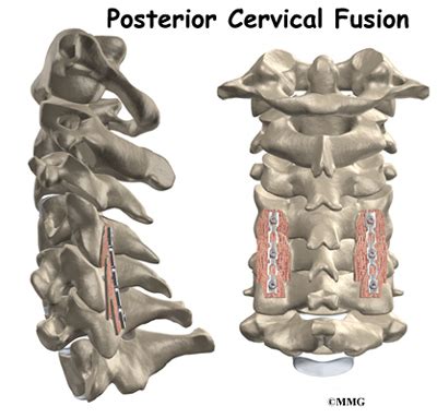 Posterior Cervical Fusion - eOrthopod.com