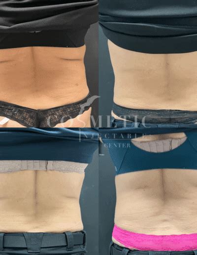 Emsculpt Neo Before And After Photo Gallery Sherman Oaks