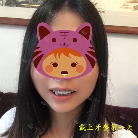 龅牙牙套 儿童 第4页 大山谷图库