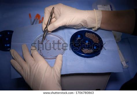 Hair Transplantation Process Pulling Hair Follicles Stock Photo