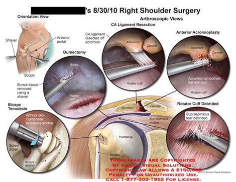 How To Rehab A Shoulder After Debridement