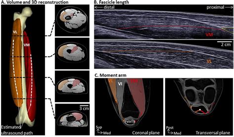 Vastus Medialis Oblique Mri