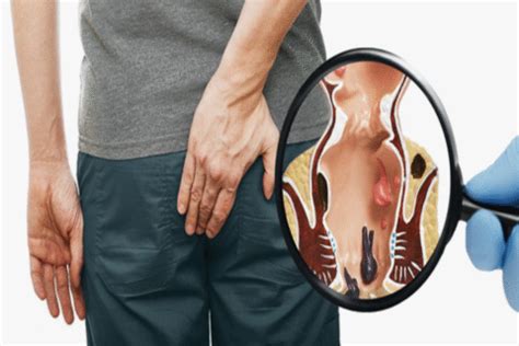 What Are Video Assisted Treatment Methods Vaaft In Anal Fistula Avrupa Cerrahi T P Merkezi