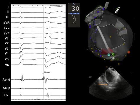 How To Map And Ablate Papillary Muscle Ventricular Arrhythmias Heart