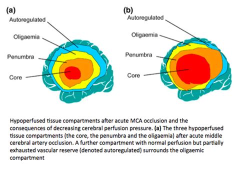 Acute Ischemic Stroke Flashcards Quizlet