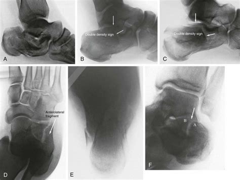 Fractures Of The Calcaneus Musculoskeletal Key