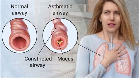 The Respiratory Tract Is Inflamed