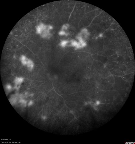 RÉTINOPATHIE DIABÉTIQUE PERPIGNAN RETINA VISION