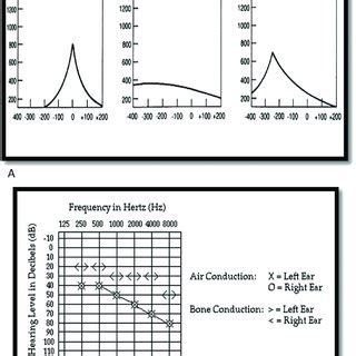 a Sample graphs of tympanometry (Type A -Eardrum movement in normal... | Download Scientific Diagram