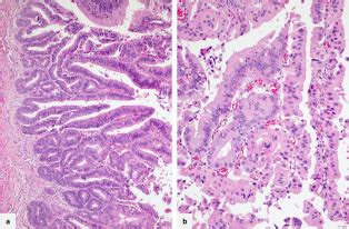 The Oncocytic Subtype Is Genetically Distinct From Other Pancreatic