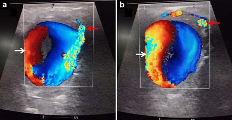 Color Doppler ultrasound images (a and b) showing the pseudoaneurysm ...