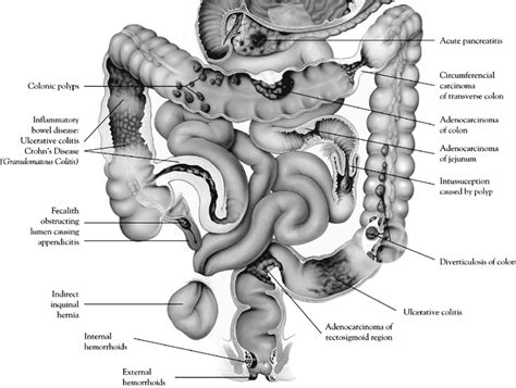 Diagram Of The Rectosigmoid