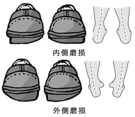 快，抬脚看看你的鞋，哪侧磨损更严重？凤凰网