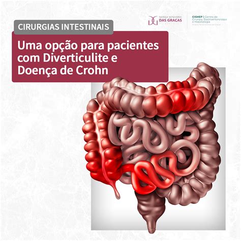 Cirurgias Intestinais Uma Op O Para Pacientes Diverticulite E