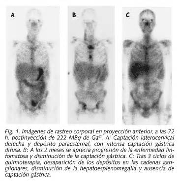 Captaci N G Strica De Galio En La Infecci N Por Virus De La