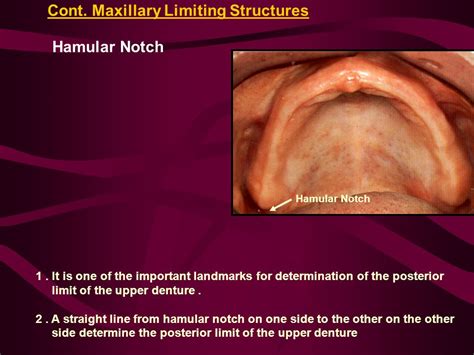 Hamular Notch Anatomy