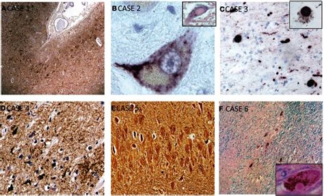 Selected Microscopic Findings On Neuropathological Examination A