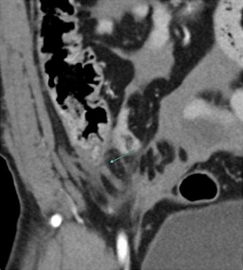 Figure 4 Showing The Transected Appendix In The CT Scan Blunt