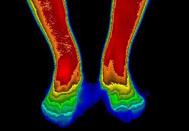 Using Infrared Imaging Before And After Shows Firefly Light Therapy