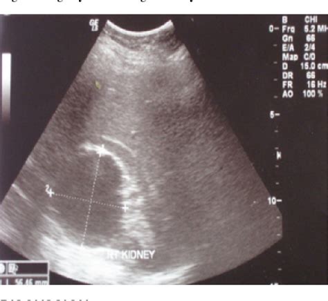 Figure 6 From Agenesis Of The Gallbladder What To Do In Such A Rare Case Presentation Of A