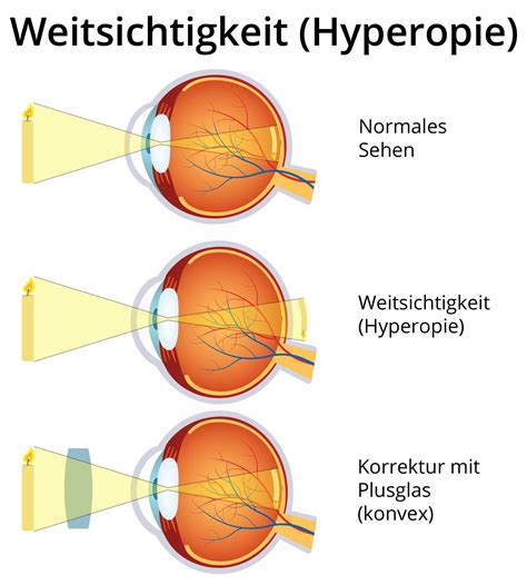 Weitsichtigkeit Hyperopie