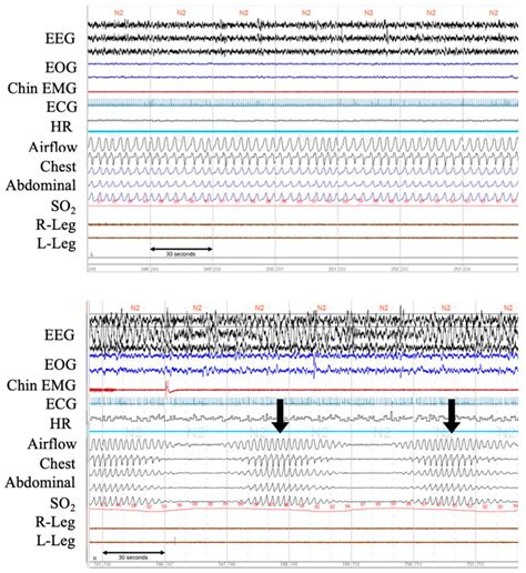 Polysomnographic Recordings Of Normal Breathing Pattern And A Clear