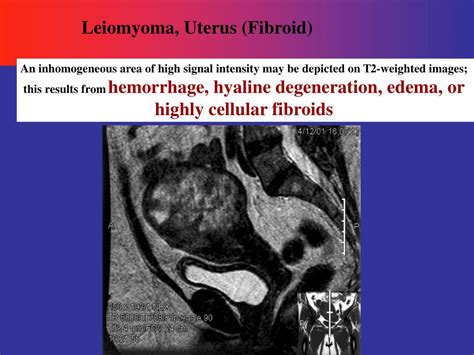 Ppt Leiomyoma Uterus Fibroid Powerpoint Presentation Free