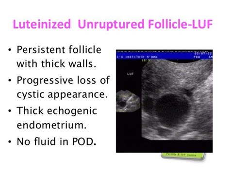 Luteinized Unruptured Follicle Luf Persistent Follicle With Thick