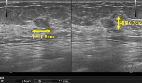 유방암검진무증상 레이디유외과 유방초음파상 양성으로 보이는 결절 60대여성 침윤성 유방암 진단 238번째