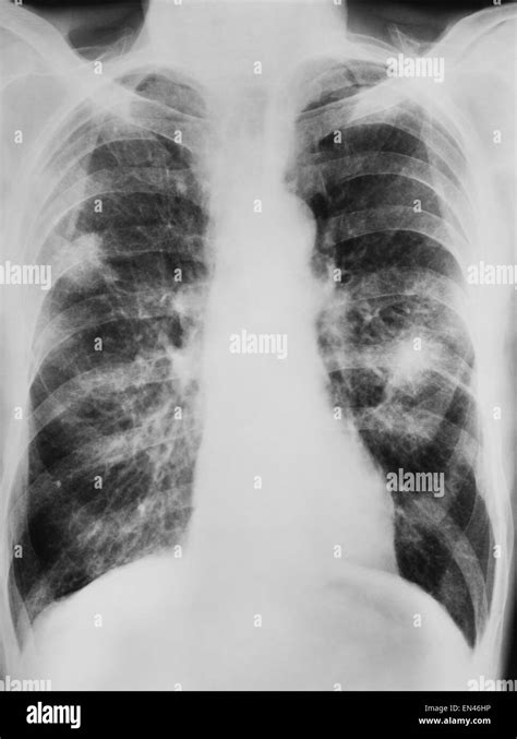 x-ray shadow on the lung engine smoker category b lung cancer of Stock ...