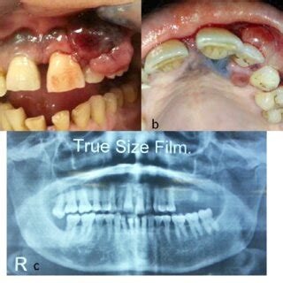 Histopathological Examination Of Intraoral Malignant Melanoma A